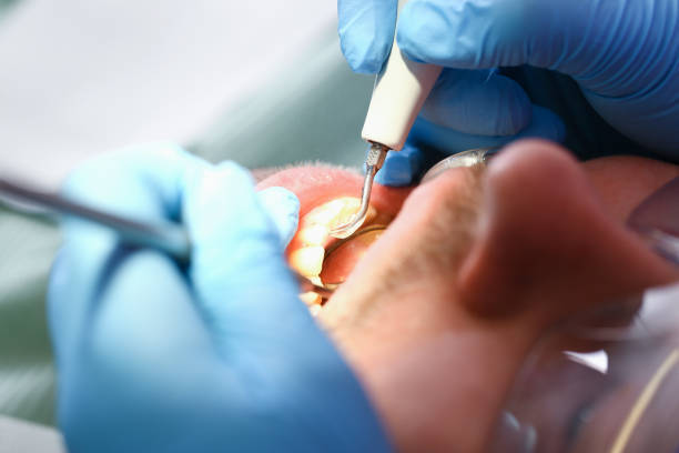 Best Emergency Dental Care for Broken or Chipped Teeth in Murphys, CA