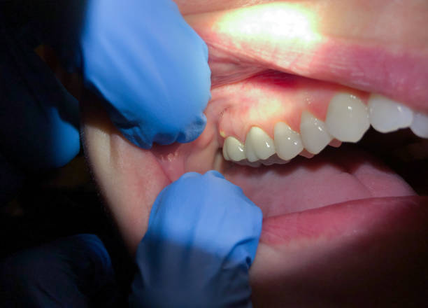 Best Emergency Treatment for Dental Infections or Abscesses in Murphys, CA